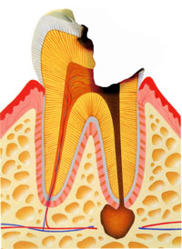 神経に到達する虫歯.jpg