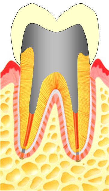 仮歯の図.jpg