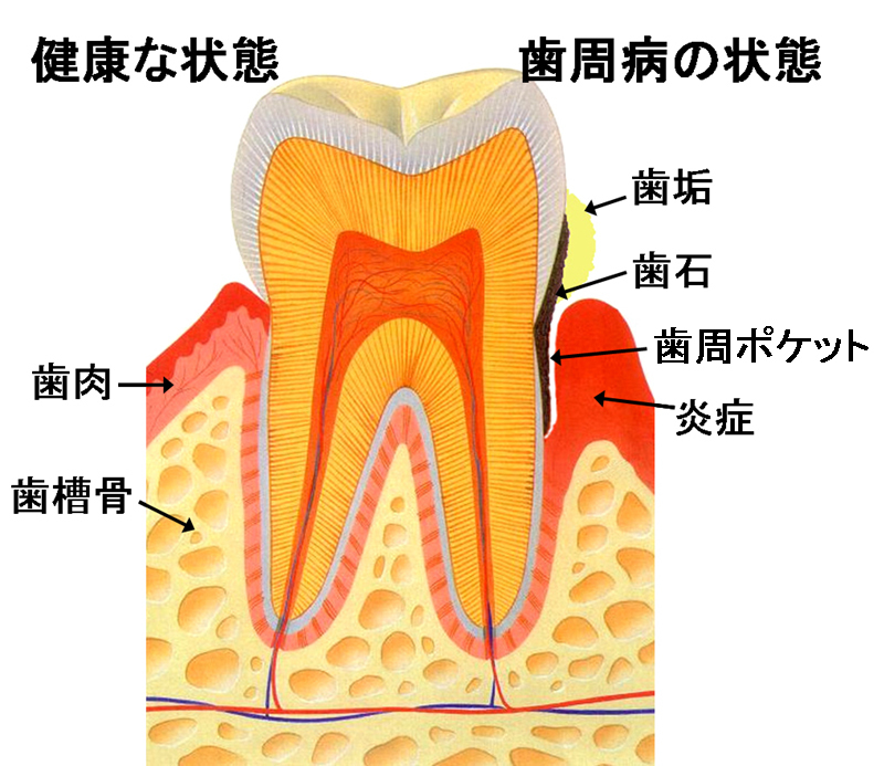 歯周病の絵.jpg