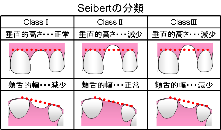 Seibertの分類.jpg