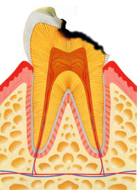 大きな虫歯.jpg