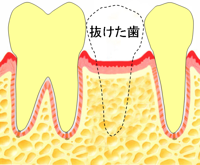 欠損補綴術前.jpg