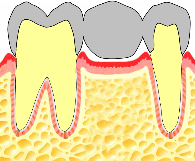 欠損補綴ブリッジ２.jpg
