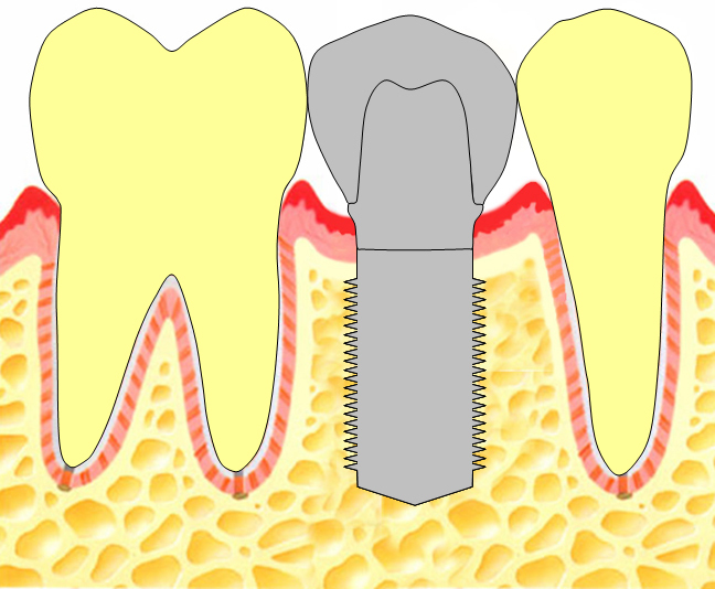 欠損補綴インプラント.jpg