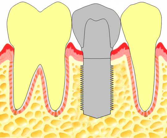 見る目が変わる！　「欠損歯列」の読み方，「欠損補綴」の設計 BK04830.jpg